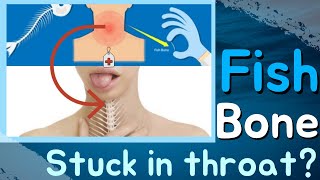 What to Do When a Fish Bone Gets Stuck in Your Throat [upl. by Sheela]