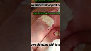 Pericoronitis treatment at siri dental with laser no blood no sutures and faster healing also [upl. by Htidirrem]