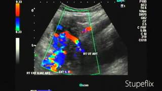 Color Doppler video of uterine artery in 2nd trimester [upl. by Karel]