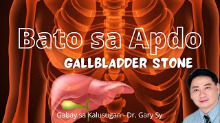 Gallbladder Stone  Dr Gary Sy [upl. by Gemma]