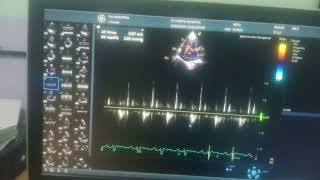 Global hypokinesia of lv severe lv severe TR moderate MR [upl. by Karilla261]