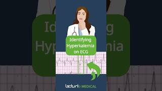 Key ECG Clues for Hyperkalemia 📊 [upl. by Aicsila]