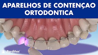 APARELHOS DE CONTENÇAO  Como evitar que os dentes se desloquem após a ortodontia © [upl. by Bowman576]