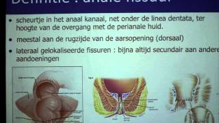 Anale fissuur  proctologie  Dr Tom Feryn [upl. by Norab]