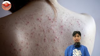 The MOST TERRIFYING Acne Squeezing Videos Youve Ever Seen 3 [upl. by Aniratac]