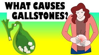 What Causes Gallstones Major Causes Of Gallstone Disease Gallstones Causes [upl. by Hoashis]