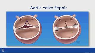 Valve Repair for Bicuspid Aortic Valve Related Aortic Regurgitation [upl. by Nnahteb]