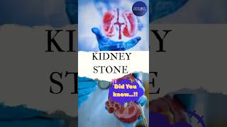 Kya apko kidney stone haikidney kidneystone kidneyhealth trending yt kidneystonetreatment [upl. by Eynttirb980]