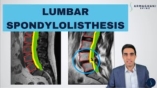 Lumbar Spondylolisthesis  Anatomy Symptoms Causes Treatments and more [upl. by Eitac591]