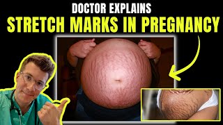 Doctor explains STRETCH MARKS in PREGNANCY  including signs clinical photos causes treatment [upl. by Friedberg320]