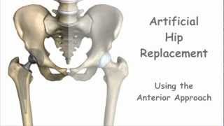 Artificial Hip Replacement  Anterior Approach [upl. by Zurheide850]