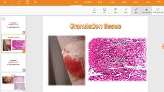 Granulation tissue 1st step of repair [upl. by Osman]