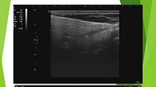 Echographie de la parotide le piège [upl. by Saba]