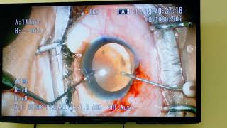 Cataract Surgery with present of Iris Coloboma [upl. by Etheline]