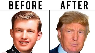 Donald Trumps Hair Transplant  Plastic Surgery Analysis [upl. by Abshier]