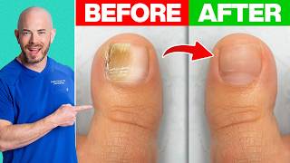 How to Treat Toenail Fungus  Derm Recommends [upl. by Khichabia]