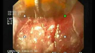 BARRETT ESOPHAGUS HALO 90 ABLATION CHRISTOS KARALIS MDwmv [upl. by Chane616]