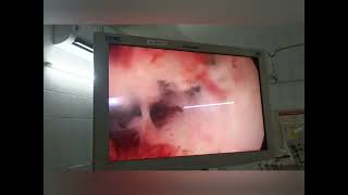 Hysteroscopic Polypectomy Slicing technique detailsvivekanandahospitalofficial [upl. by Watt]