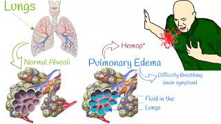 Pulmonary edema  Mechanism of action [upl. by Dawson869]