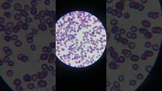 Microcytic hypochromic anemia  anemia  special smear  iron diffiency Anemia anemia under 🔬 [upl. by Adamski]