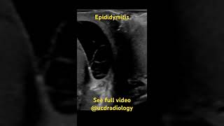 Epididymitis radiologist radiology ultrasound medicine medicalschool [upl. by Ethbin]