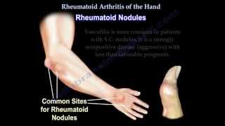 Rheumatoid Arthritis of the hand  Everything You Need To Know  Dr Nabil Ebraheim [upl. by Hgielah725]