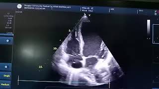 Good CaseSevere hypokinesia and aneurysm of LV apex with suspicion of clot Mild TR Chiari network [upl. by Llehsar]