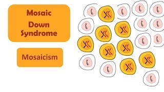 Mosaic Down Syndrome  Mosaicism  A type of Down Syndrome [upl. by Dupuis]