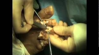 Hammer ToeSmart Toe Surgery  Dr Sherman Nagler  Houstons Foot Doc [upl. by Alletnahs]