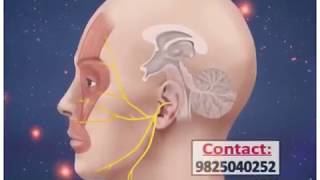 Trigeminal neuralgia treatment radio frequency ablation in ahmedabad gujrat [upl. by Snyder174]