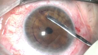 DMEK surgery sutureless corneal transplant [upl. by Kylen]