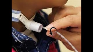 tracheostomy suctionالعنايه التمريضية لانبوب الفتحة العنقية الرغامية [upl. by Mairym]