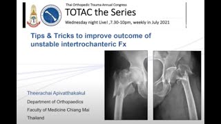 TOTAC2021 Ep2 Part 410 Tips amp Tricks for unstable intertrochanteric Fx By DrTheerachai CMU [upl. by May861]