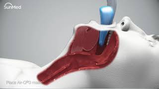 AirQ3®Intubating Laryngeal Airways InService Animation [upl. by Feucht174]