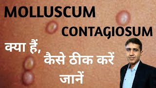 Molluscum Contagiosum क्या है कैसे पहचाने कारण व् होम्योपैथिक इलाज  Molluscum Contagiosum Ka Ilaj [upl. by Acinaj612]