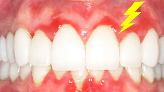 Every Cause For SORE GUMS and Why They Hurt Plus How To Get Aching Pain Relief w Home Remedies Too [upl. by Nosbig]