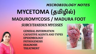 Mycetoma  Maduromycosis  Madura Foot  Subcutaneous mycoses  Dr Blessy  Tamil  Microbiology [upl. by Church]