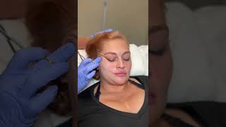 FACELIFT LIKE RESULTS IN MINUTES WITH PDO THREADS youtubeshorts pdothreadlift [upl. by Marie-Jeanne507]