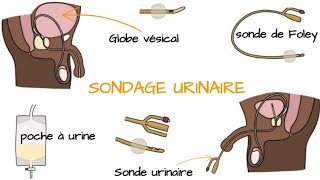 Comprendre le SONDAGE URINAIRE [upl. by Lav]