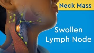 Neck Mass Swollen Lymph Node [upl. by Bindman]