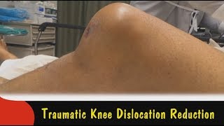 Traumatic Knee Dislocation Reduction [upl. by Sulokcin]