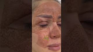 Fibroblastplasma fibroblastskintightening ترند fibroblasting skincare [upl. by Amato]