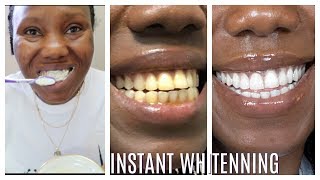 How I whitened my yellow teeth in 2 Minutes  LIVE DEMO HOME REMEDY [upl. by Ykcim]