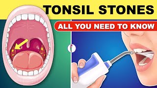 Tonsil Stones  Tonsil Stones Treatment  Tonsil Stone Removal  All You Need to Know [upl. by Gladdy]