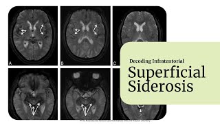 Decoding Superficial Siderosis [upl. by Danella935]