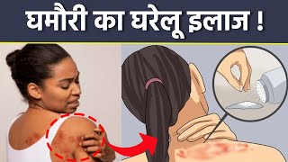 Heat Rash Treatment Ghamori Ka Gharelu Upay  घमौरी कैसे ठीक करें  Boldsky [upl. by Aimal]