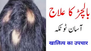 Balchar ka ilaj  How to treat alopecia  Balchar home remedy  Ganjapan ka ilaj  Gharelu nuskha [upl. by Emyle]