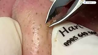 Blackheads Removal from the Nose with Haris  Satisfying [upl. by Navonod]