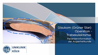 Glaukom Grüner Star OP  Trabekulektomie Patienteninformation Augenklinik  Uniklinik Köln [upl. by Novej]