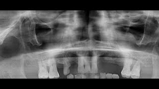 Multiple teeth extraction with chronic irreversible pulpitis [upl. by Efeek]